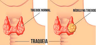 Entendendo N Dulos Tireoidianos Como Diagnosticar Quais Os Cuidados